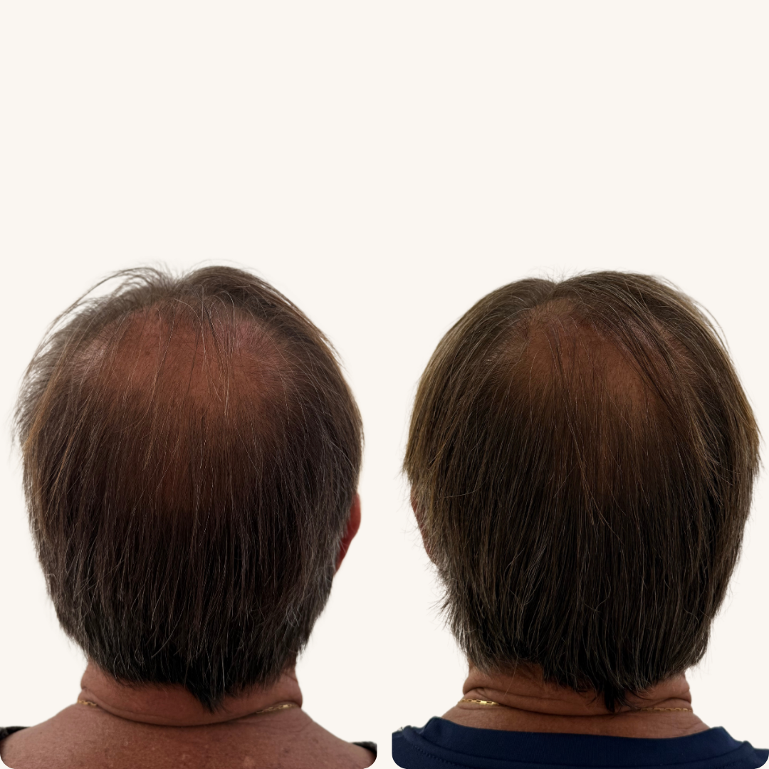 Antes e Depois - Terapia Capilar 2