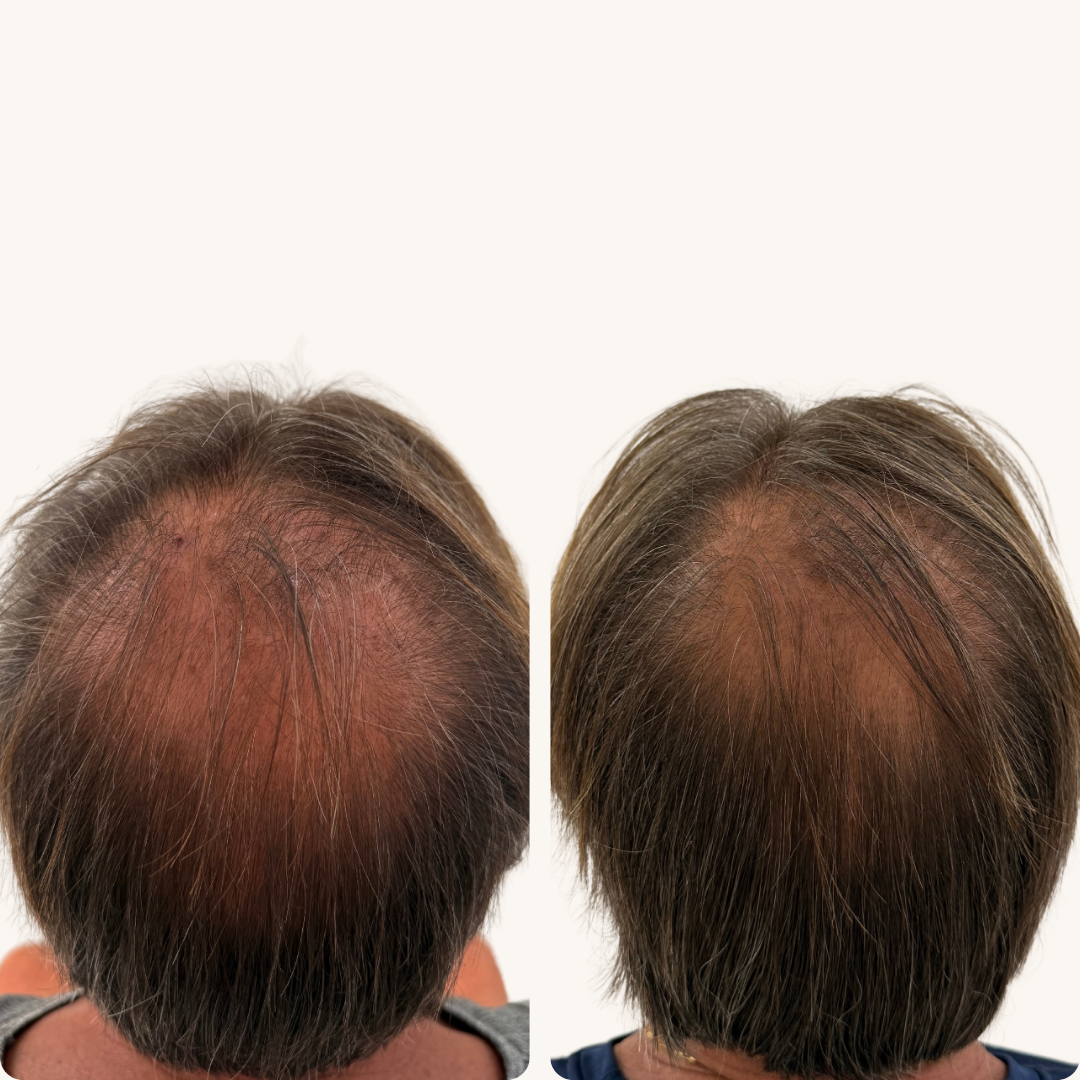 Antes e Depois - Terapia Capilar 1