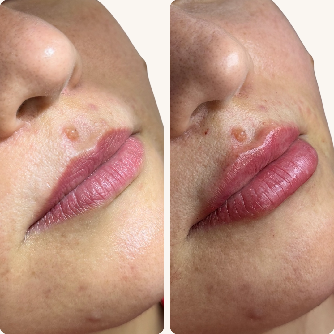 Antes e Depois