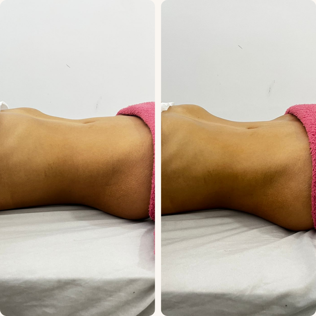 Antes e Depois