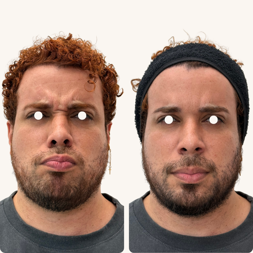 Antes e Depois - Toxina Botulínica 2
