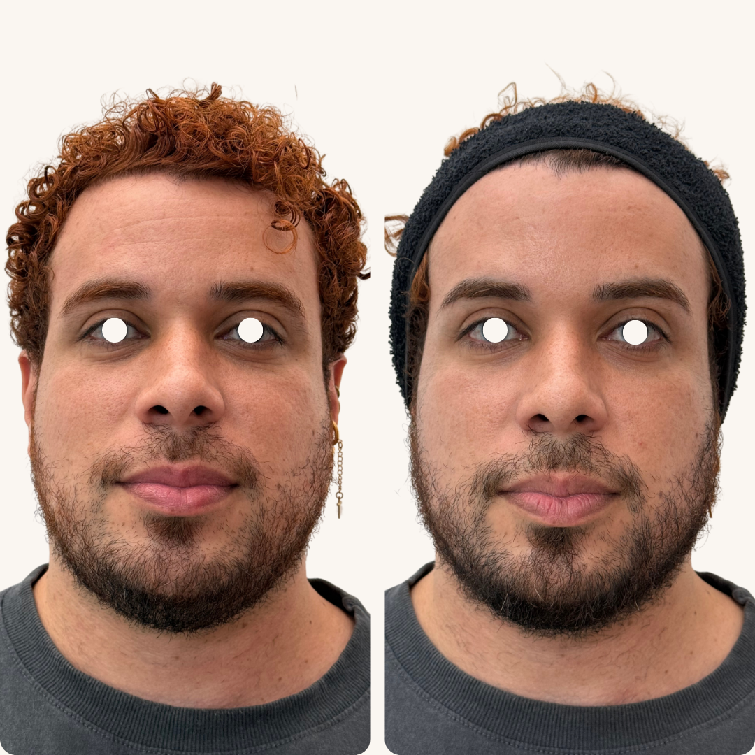 Antes e Depois - Toxina Botulínica 1