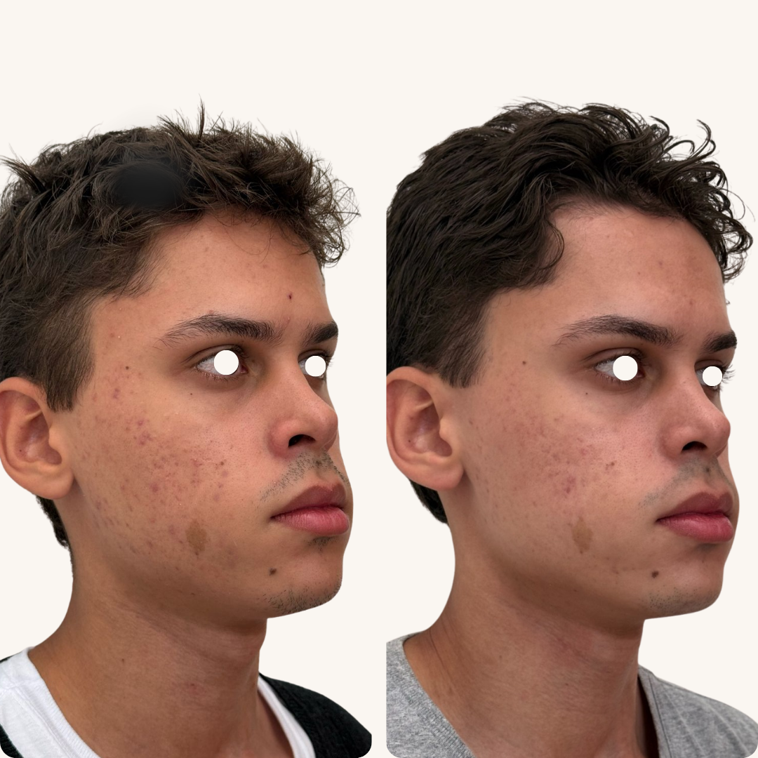 Antes e Depois